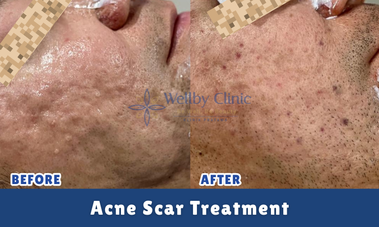 Acne Scar Treatment