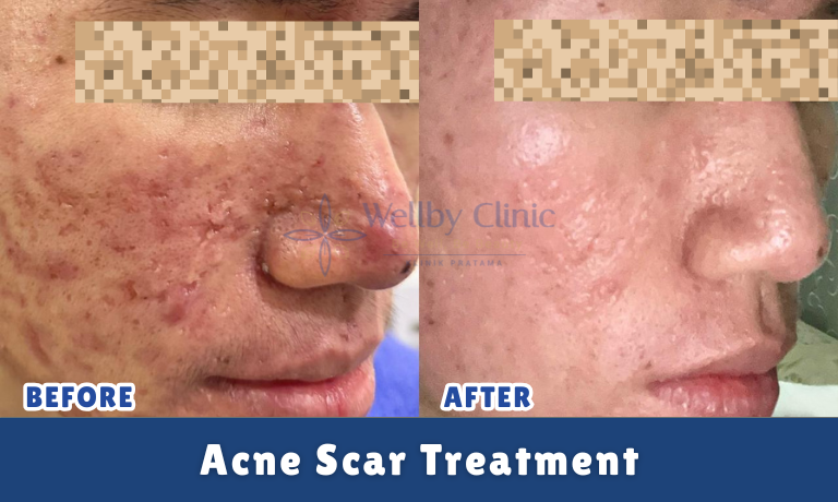 Acne Scar Treatment
