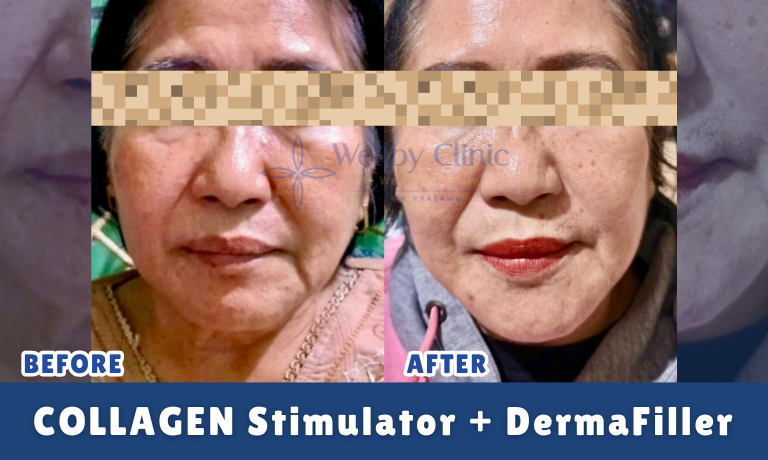Collagen Stimulator + Dermafiller