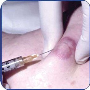 Injection Keloid
