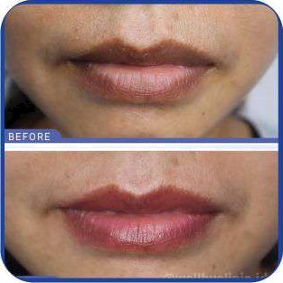 Korean Baby Laser Lips